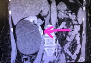 Новороссийские хирурги с помощью лапароскопии удалили пациентке крупную кисту почки