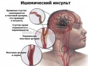 В неврологическом отделении Регионального сосудистого центра горбольницы Новороссийска спасли пациента с ишемическим инсультом